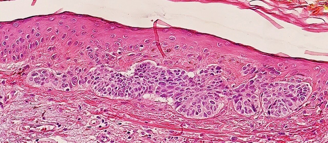 Chemotherapy-induced alopecia: which regimens cause permanent loss