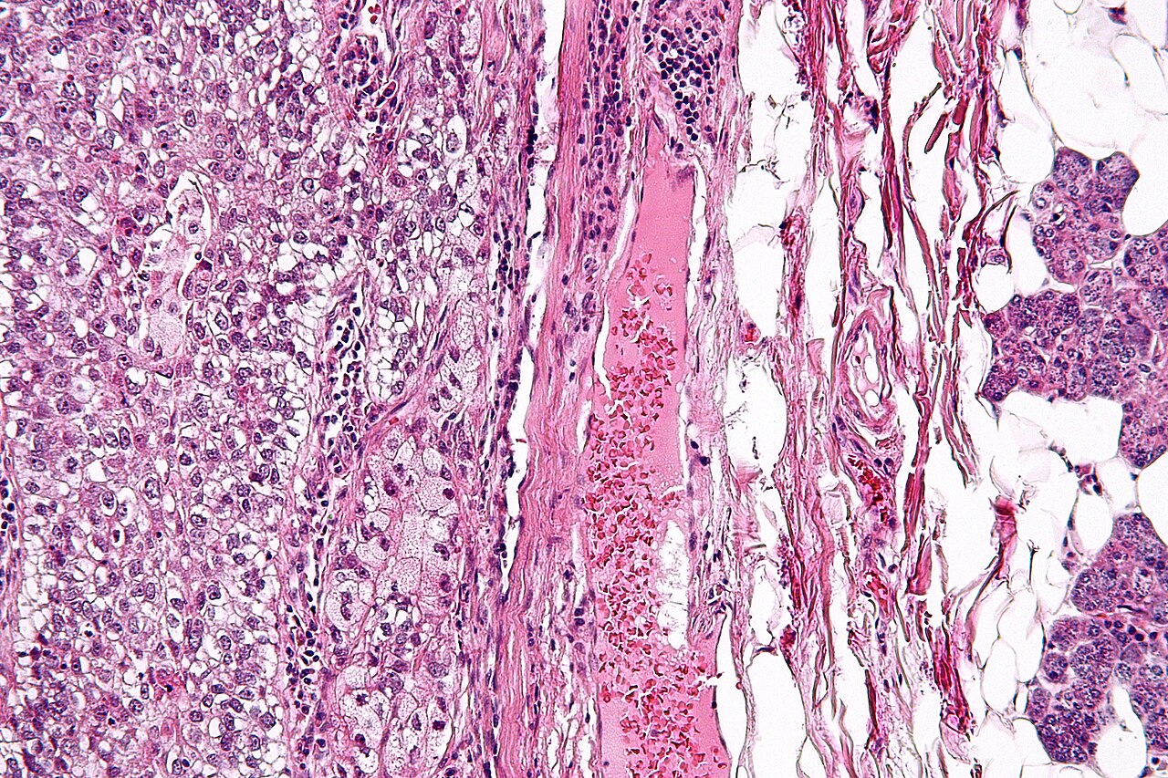 This is a hematoxylin and eosin stained slide at 10x of the insertion of sebaceous glands into hair shaft in a full, normal pilosebaceous unit, sectioned from tissue also found to have a benign intradermal nevus.