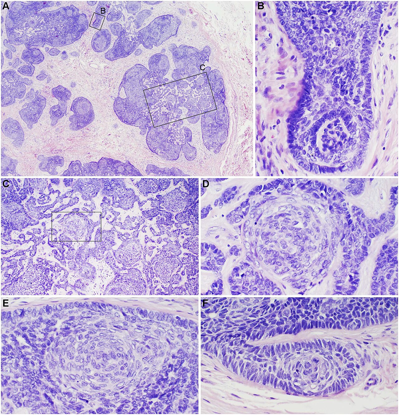Human trichoblastoma : A trichoblastoma from a 68 year-old Caucasian male showed a pseudo-encapsulated, multinodular, basaloid tumor with fibrocellular stroma spanning the reticular