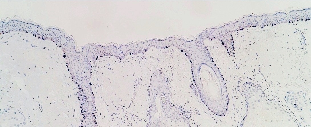 SOX10 immunohistochemistry of atypical melanocytic proliferatio, seen mainly in hair follicles.