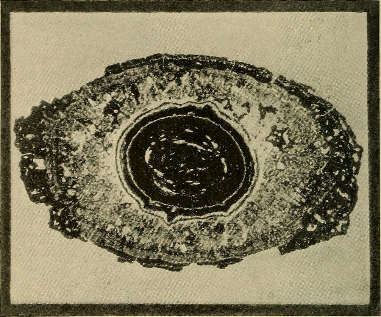 Ophiasis pattern alopecia areata and why it resists treatment