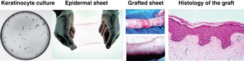 Dermatoscopic high-magnification trichoscopy comparing baseline follicular architecture to treated scalp.