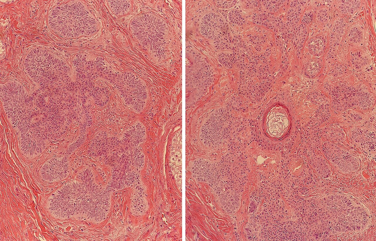 Histology of a hair follicle at two levels. The pattern in left image has similarities to basal-cell carcinoma, but section at an adjacent level reveals distinct hair follicle structures.
