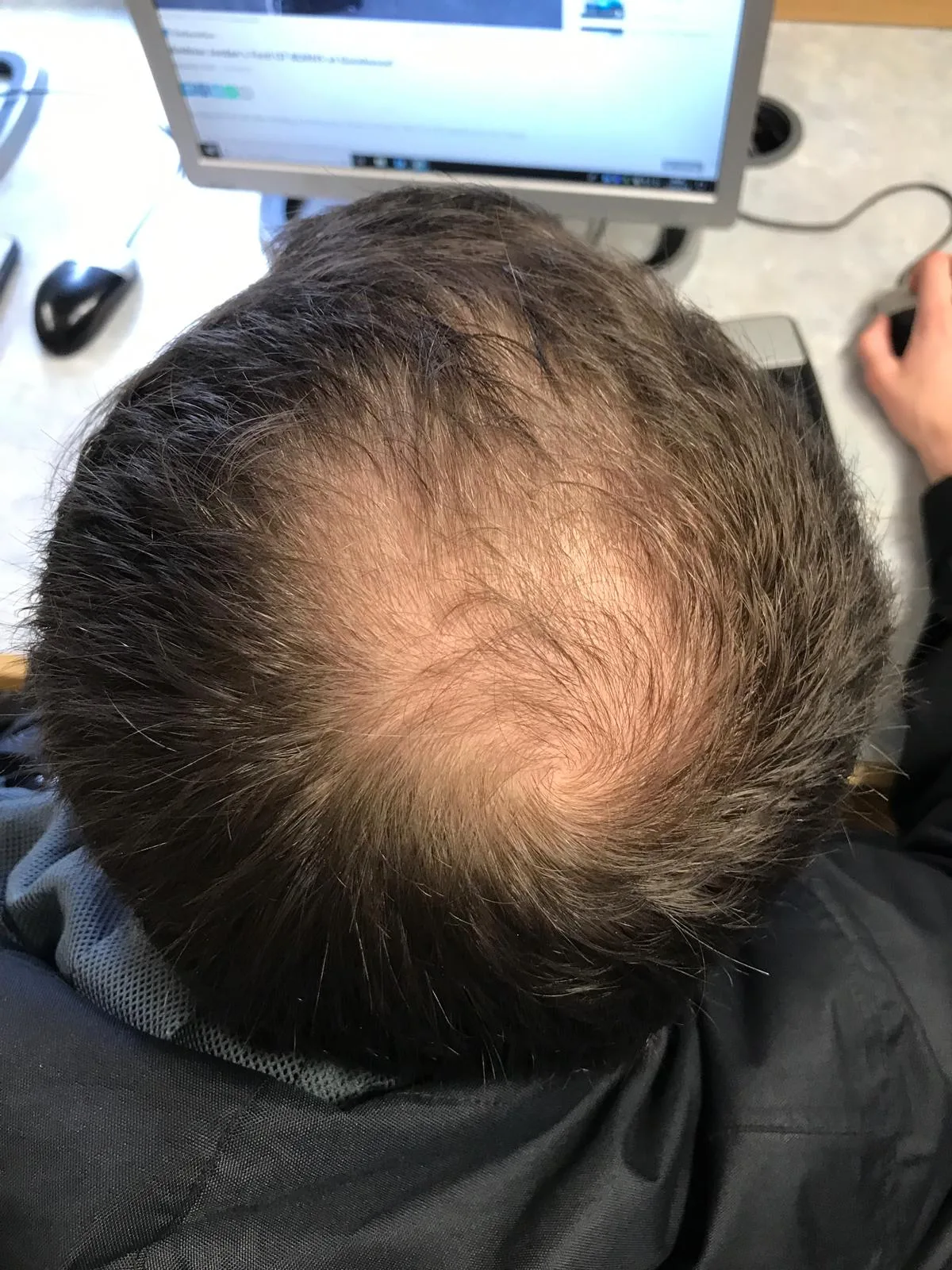 Pattern hair loss progression: the target indication for pyrilutamide.