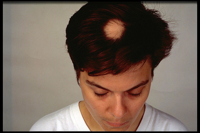 Alopecia areata.