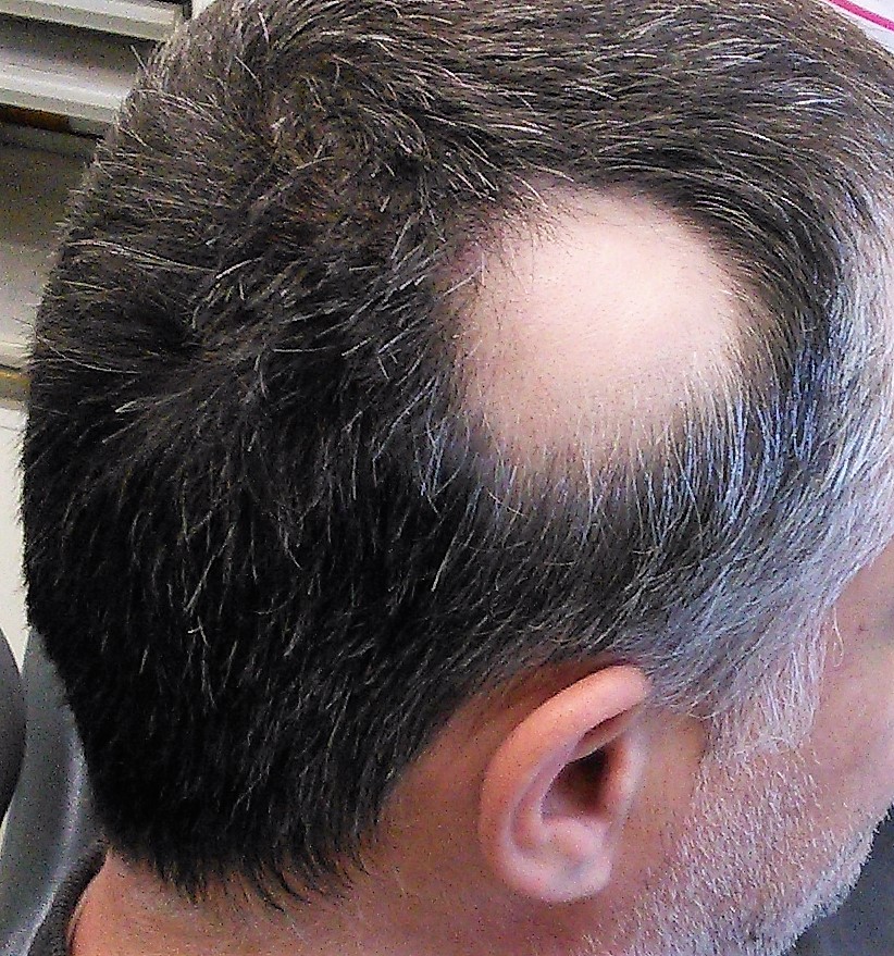 Alopecia areata