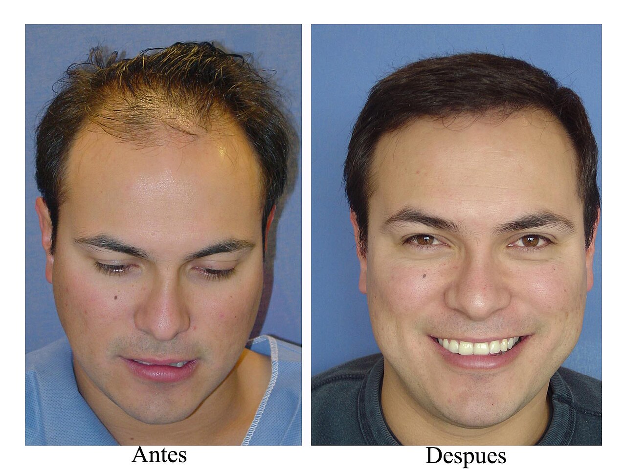The Future of Hair Restoration: Robotic FUE and Follicle Multiplication Converge