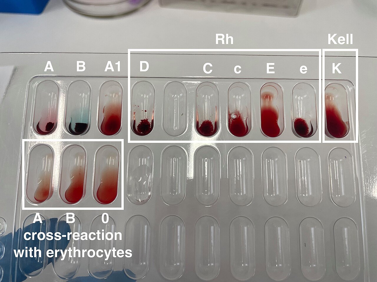 The Hidden Iron Threshold: Uncovering the Link Between Ferritin and Hair Loss