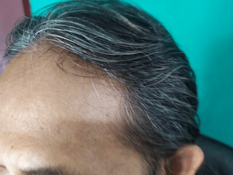 the man has receding hairline and he consider it to do hair transplant surgery