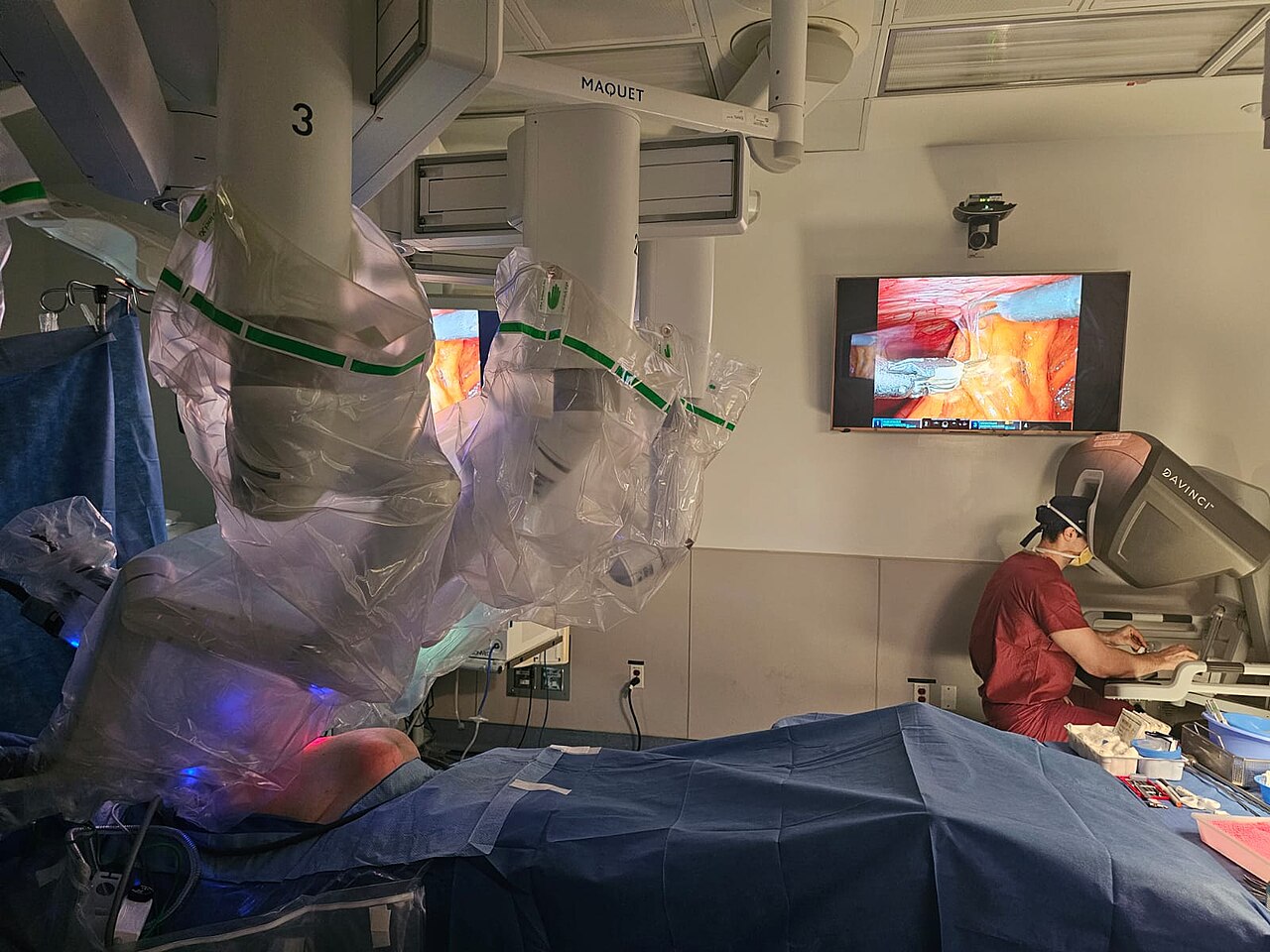 A surgeon at the Columbia Hernia Center operates on a patient with a large hernia using the robotic platform.