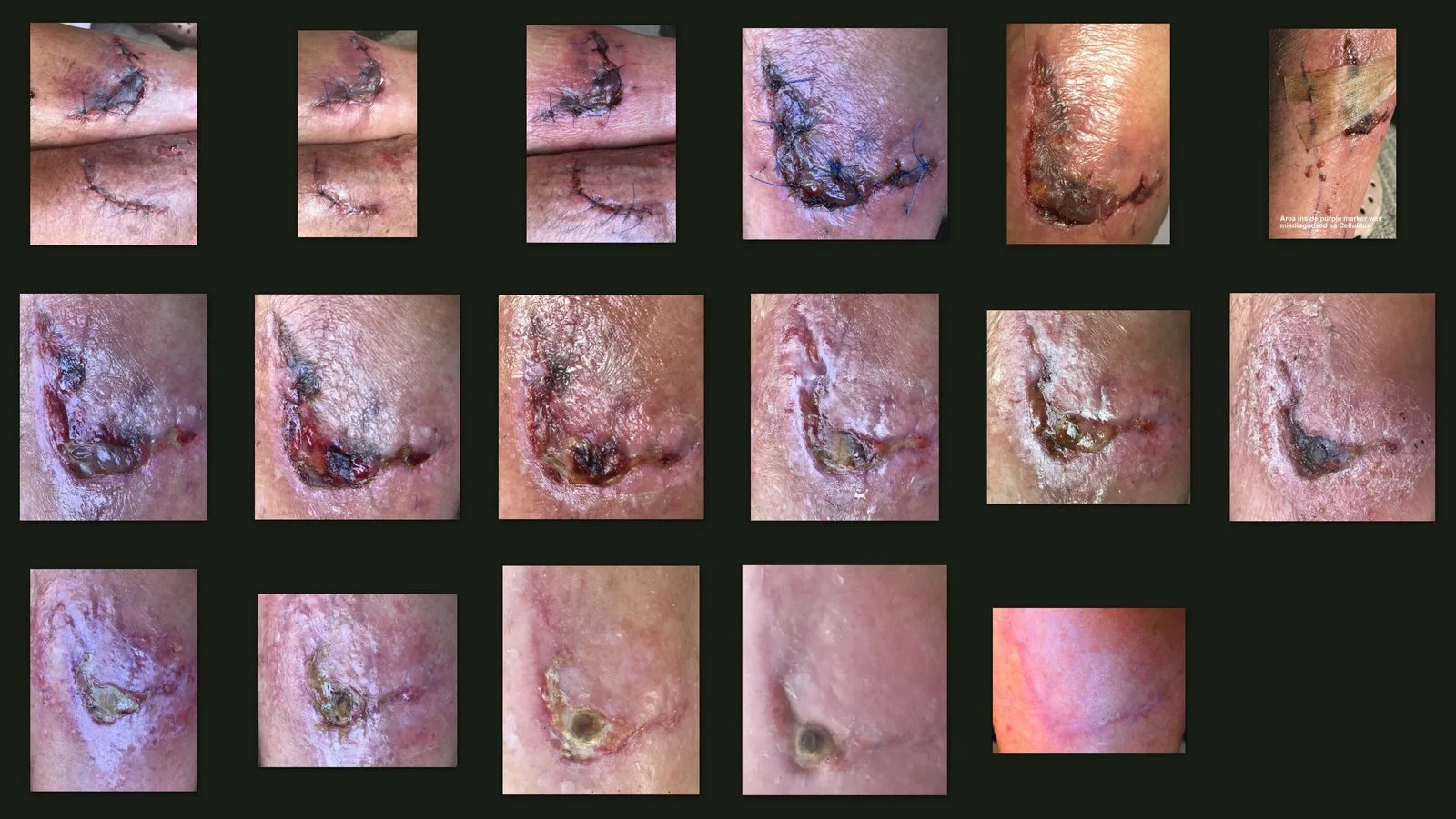 Stages of wound healing relevant to verteporfin's anti-scar mechanism.